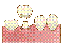 保険適用のハイブリッドレジン