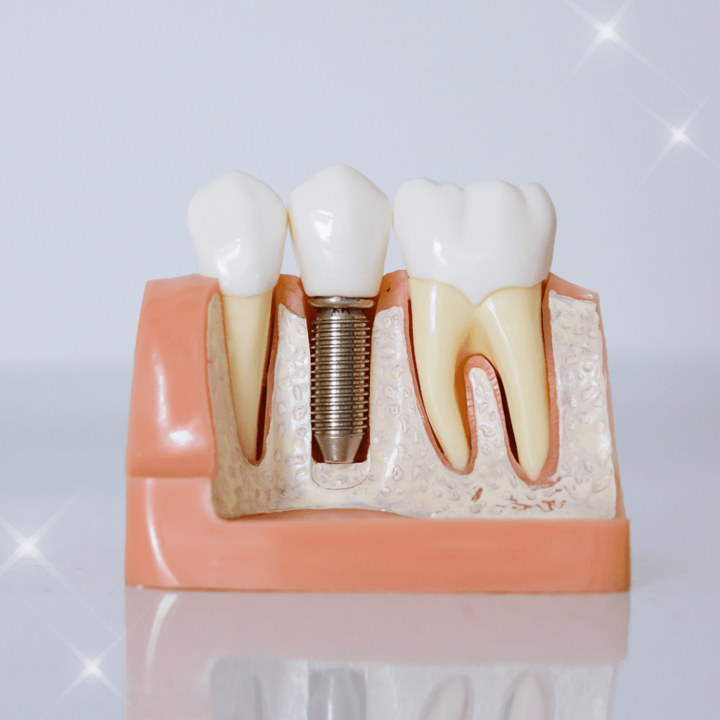 インプラントの模型