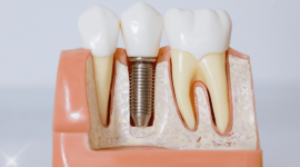 インプラントの模型